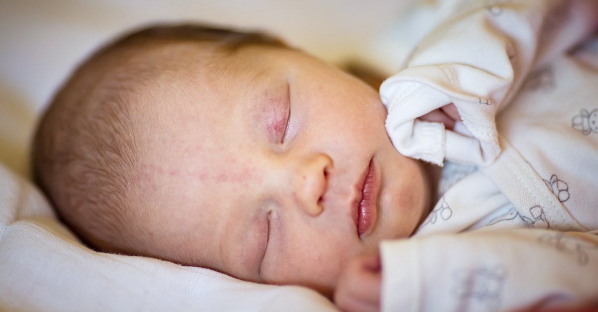 Baby mit Storchenbiss